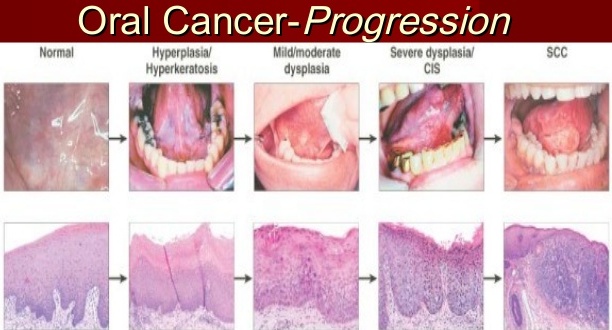 mouth cancer symptoms