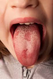 What to Know about Oral Thrush1 - Who Gets Attacked by Oral Thrush?