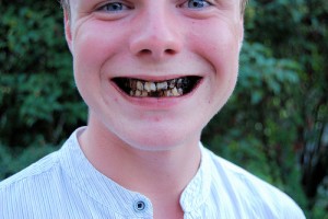 The Nasty Truth of Rotten Teeth 300x200 - Nasty Fact of Rotten Teeth