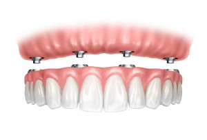 Advantages of Dental Implant Technology 300x203 - Perks of Dental Implant Technology