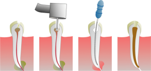 Root Canal Procedure – Smoker’s Most Needed Treatment 300x141 - Root Canal For Smokers