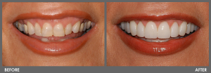 Achieve New Look thru Dental Veneers 300x104 - Achieve New Look thru Dental Veneers