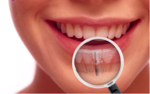 Dental Treatments that Boost Smile 300x187 - Dental Treatments that Boost Smile