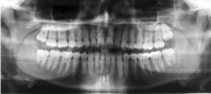 Why Consider Panorex Dental X Ray 300x134 - Why Consider Panorex Dental X-Ray?