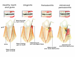 Periodontist Your Gum Health Expert 300x231 - Periodontist: Your Gum Health Expert