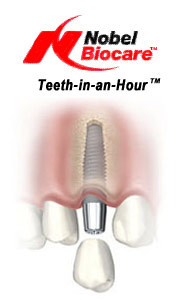 Nobel Teeth In An Hour Toothless Patients Greatest Solution 2 187x300 - Toothless Patients' Greatest Solution