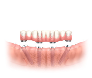 Nobel Teeth In An Hour Toothless Patients Greatest Solution 300x253 - Toothless Patients' Greatest Solution