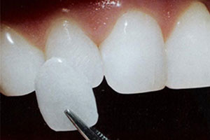 What to Experience from daVinci Veneers 300x200 - What to Experience the daVinci Veneers?