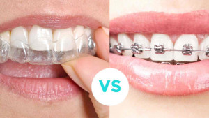 Things to Love about Invisalign Braces 300x169 - Things to Love about Invisalign Braces