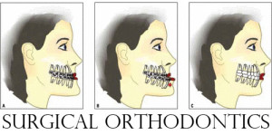 Improve Jaw Health thru Surgical Orthodontics 300x149 - Improve Jaw Health thru Surgical Orthodontics
