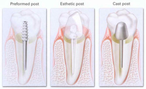 Learn the Post Crown Procedure 300x184 - Learn the Post &amp; Crown Procedure