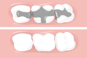 Dental Filling Types Uses 300x200 - Dental Filling Types &amp; Uses