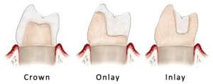 Restore Teeths Natural Grace thru Dental Onlays 300x118 - Restore Teeth's Natural Grace thru Dental Onlays