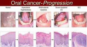 The Warning Signs Symptoms of Mouth Cancer 300x162 - The Warning Signs &amp; Symptoms of Mouth Cancer