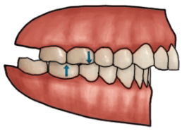 Overcome Overbite thru Dental Care - Overcome Overbite thru Dental Care