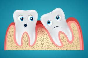 Impacts of Impacted Wisdom Teeth 300x200 - Impacts of Impacted Wisdom Teeth